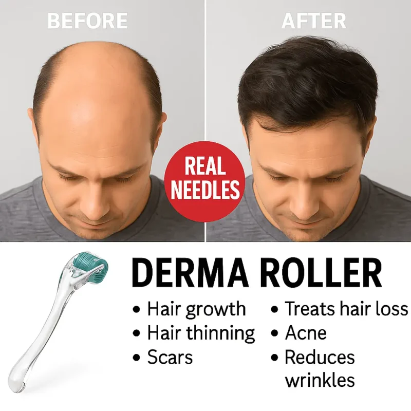 Baldness to thick haired transformation with derma roller
